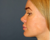 Feel Beautiful - Revision Rhinoplasty 202 - After Photo